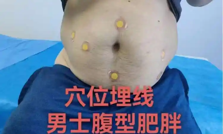 埋线减肥和穴位埋线培训中较重要的穴位选择