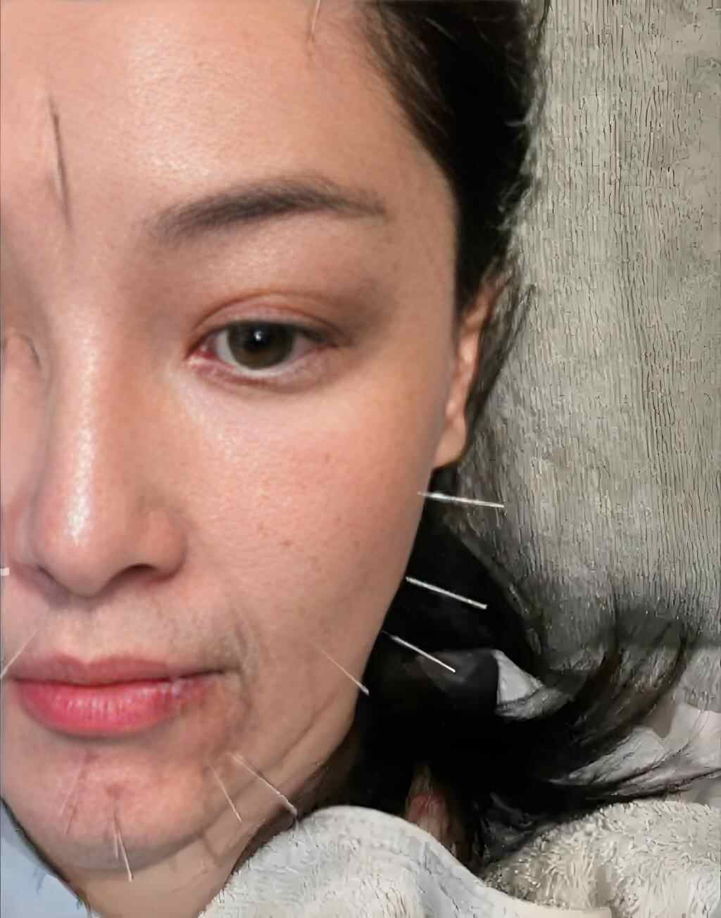 针灸美容美雕为什么这么火？山东济南针灸美容美雕培训班公立医院