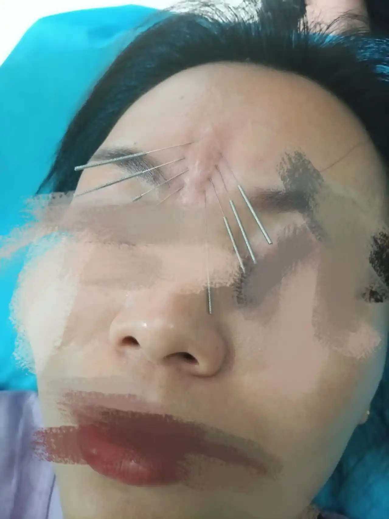 针灸美雕改善川字纹的实操手法教学